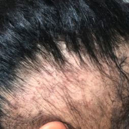 My Hair is Thinning, What Should I Do?